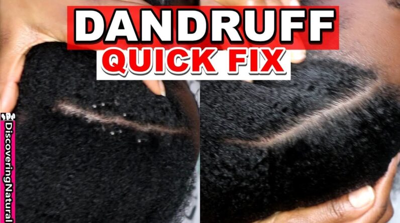 Dandruff Flakes Removal and Dandruff Treatment