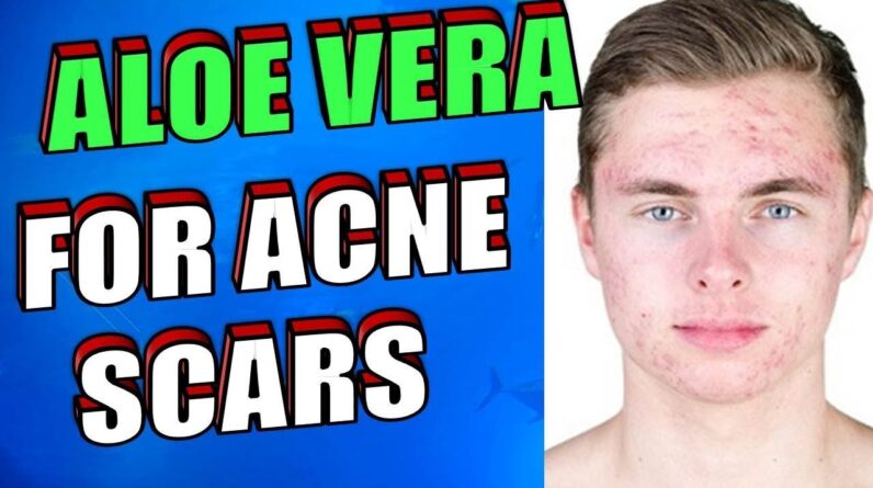 How To Use Aloe Vera OVERNIGHT To Treat Acne Scars, Pimples & Zits