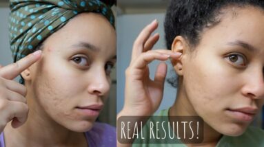 I Used Frozen Aloe Vera On My Skin For 5 Days & This Happened! | CaliCurls